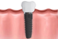 Avantajele implanturilor dentare