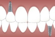 Implanturi Dentare Sky Fast&Fixed