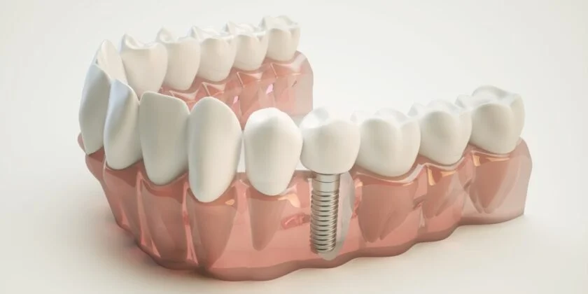 Implant Dentar Nobel