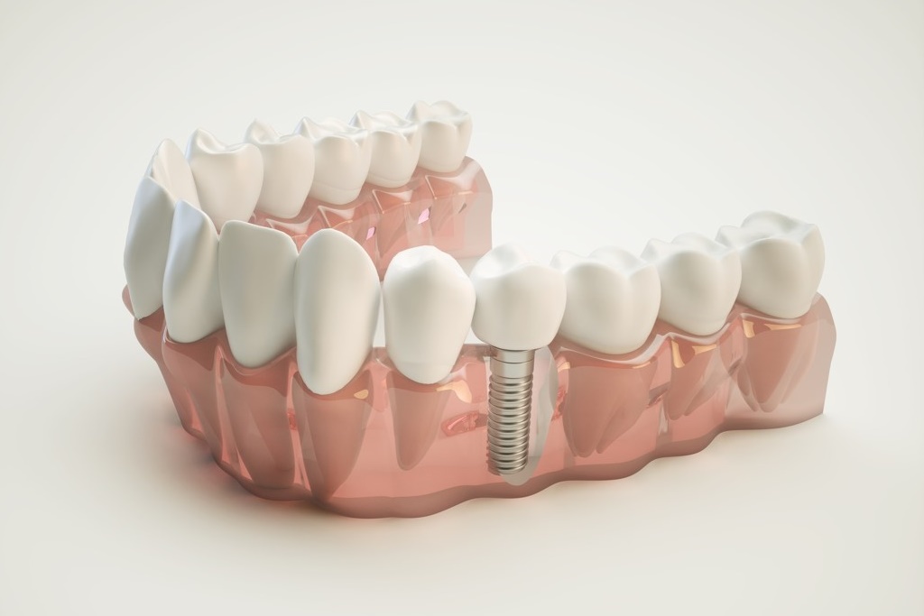 Implant Dentar Nobel