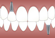 Implant Dentar All on 4/All on 6
