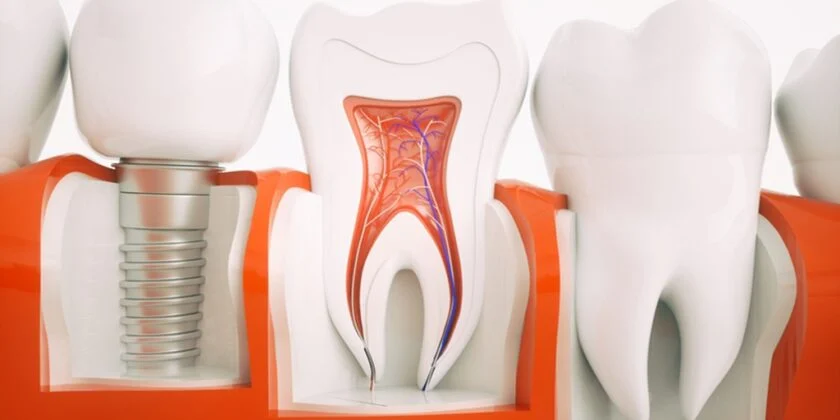 Implanturi Dentare Sky Fast&Fixed