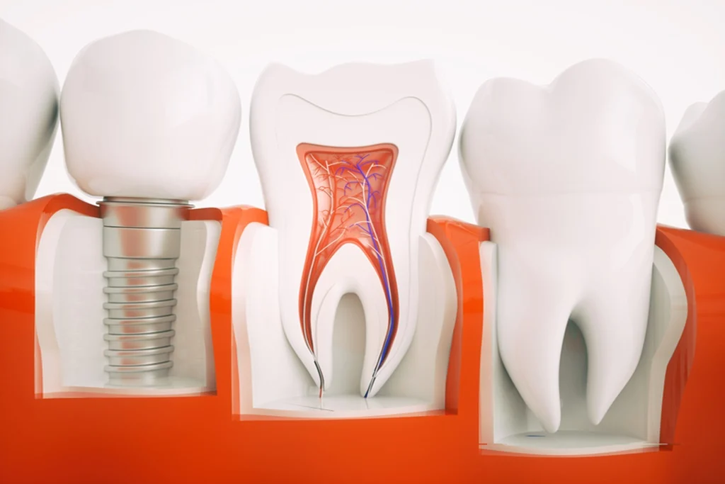 Implanturi Dentare Sky Fast&Fixed