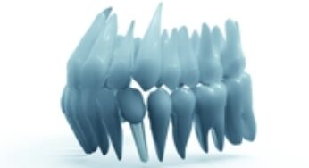 De ce sa optezi pentru un implant dentar Straumann