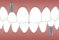 Tipuri de implant dentar