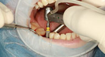 Cum se realizeaza un implant dentar de calitate?