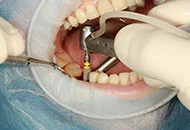 Cum se realizeaza un implant dentar de calitate?