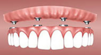 Cum se ingrijeste corect un implant dentar