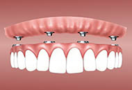 Cum se ingrijeste corect un implant dentar