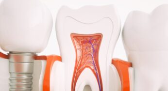 Avantajele Implantului Dentar Inno