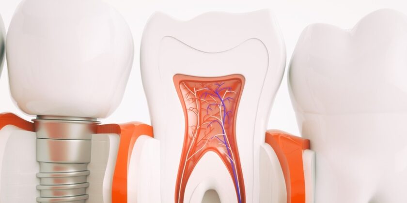 Avantajele Implantului Dentar Inno