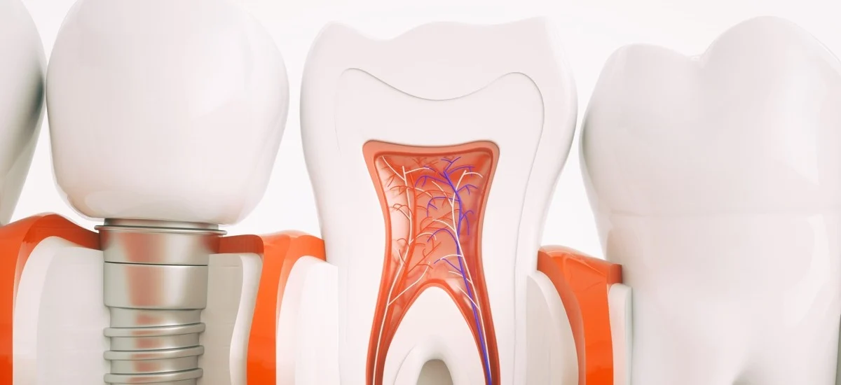 Avantajele Implantului Dentar Inno