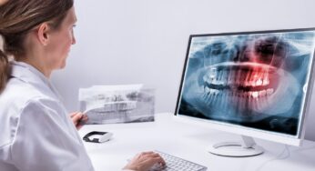 Implanturile Dentare Zigomatice