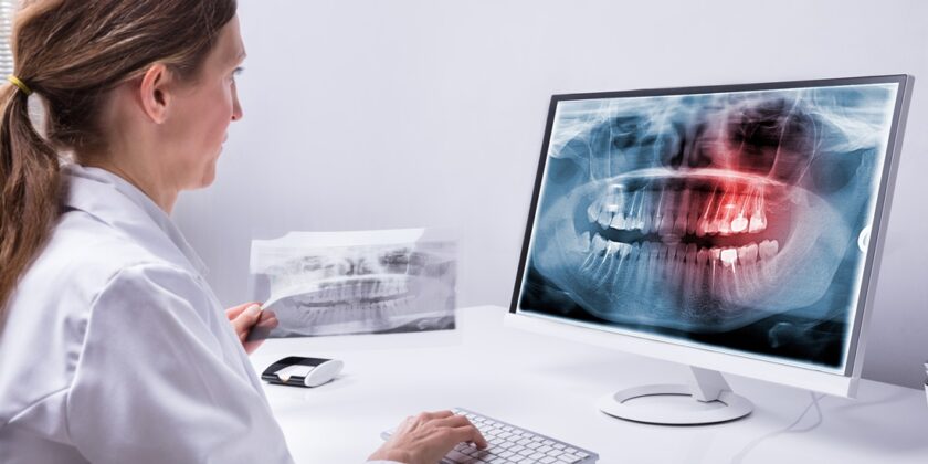 Implanturile Dentare Zigomatice