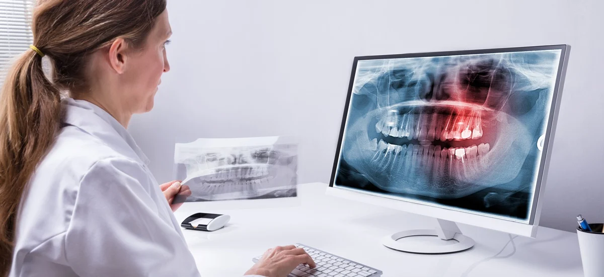 Implanturile Dentare Zigomatice