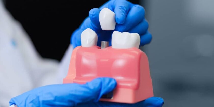 Coroana pe implant dentar