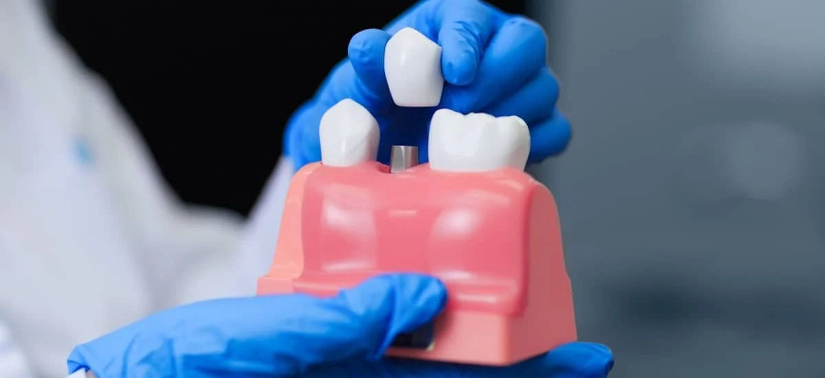 Coroana pe implant dentar