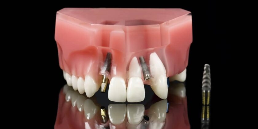 Mini implant dentar
