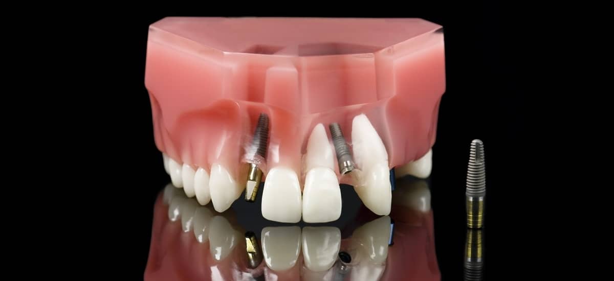 Mini implant dentar